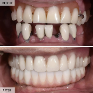 Dental Implants (Full-Mouth and Single Tooth)