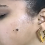 Laser Wart Removal