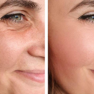 Non-Surgical Skin Tightening and Facial Rejuvenation