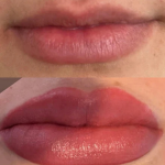 Lip Microneedling Treatment