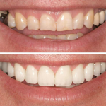 Smile Makeover and Cosmetic Dentistry