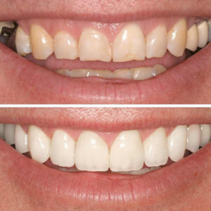 Smile Makeover and Cosmetic Dentistry