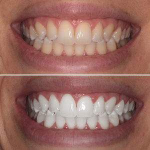 Teeth Whitening