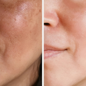 Chemical Peels and Skin Brightening