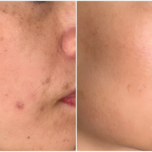 Acne, Pigmentation and Anti-Aging Treatments