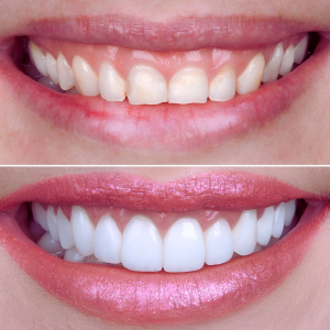 Cosmetic Dentistry Smile Makeover, Veneers, Teeth Whitening
