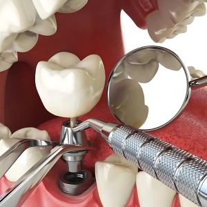 Dental Implants and Crowns