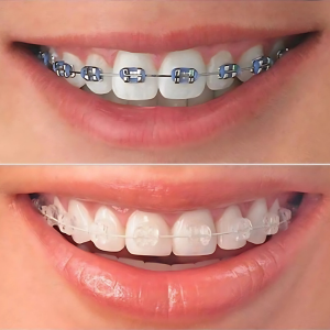 Braces and Aligners Orthodontics