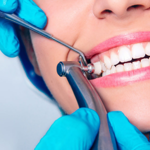Scaling and Polishing Teeth Cleaning