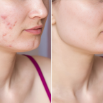 Pigmentation, Acne and Wrinkle Treatments