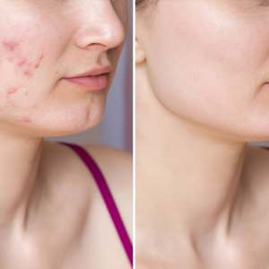 Pigmentation, Acne and Wrinkle Treatments