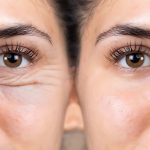 Skin Rejuvenation