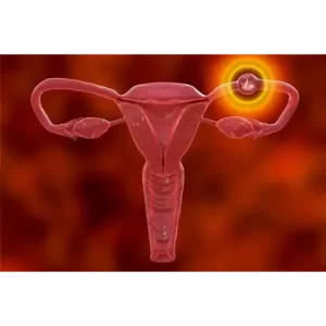 Ectopic Pregnancy