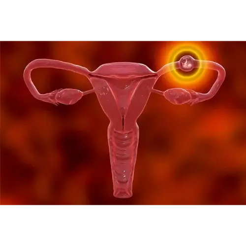 Ectopic Pregnancy