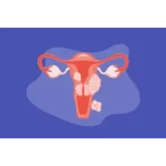 Fibroids