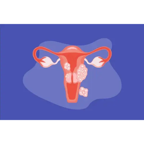 Fibroids