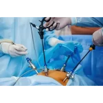 Laparoscopy