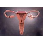 PCOS