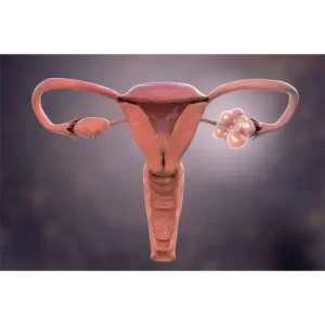 PCOS
