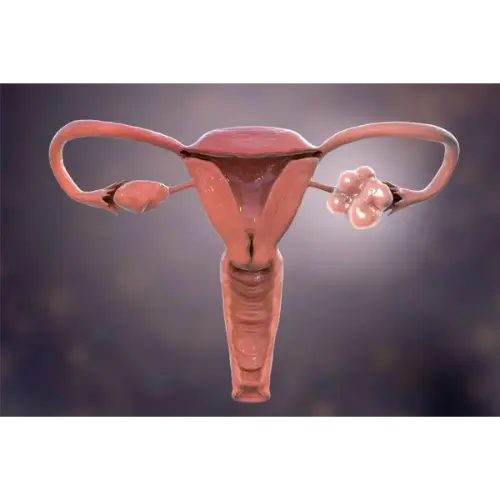 PCOS