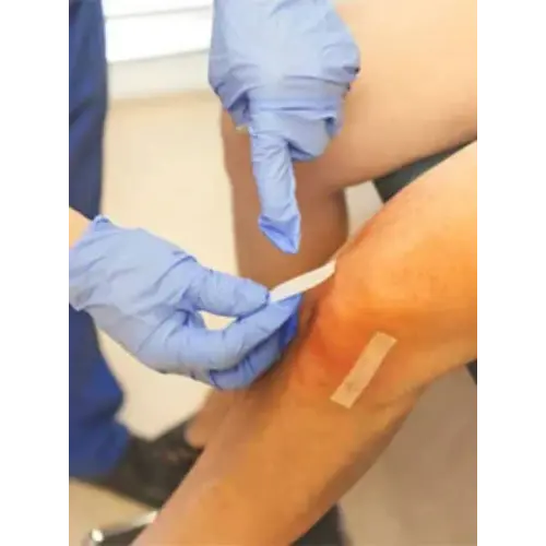 Arthroscopic ligament reconstruction