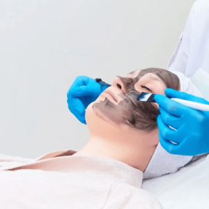 Carbon peel