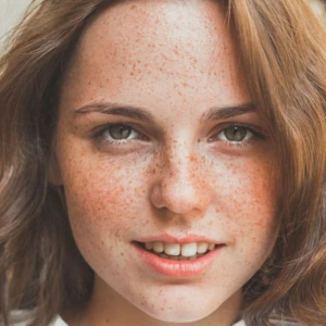 Freckles Treatment in Noida