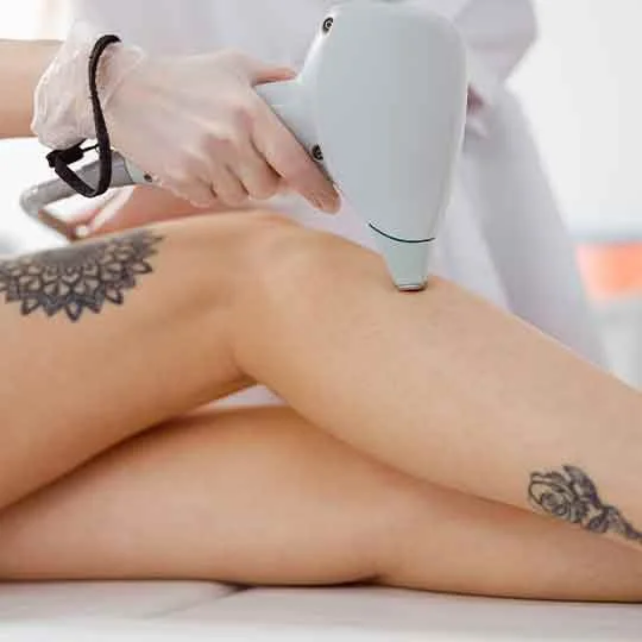 Laser Tattoo Removal