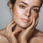 Melasma Treatment in Noida