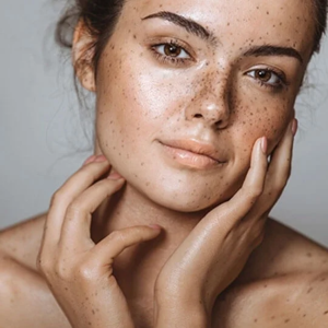 Melasma Treatment in Noida