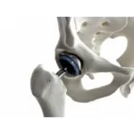 Joint Replacement