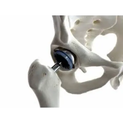Joint Replacement