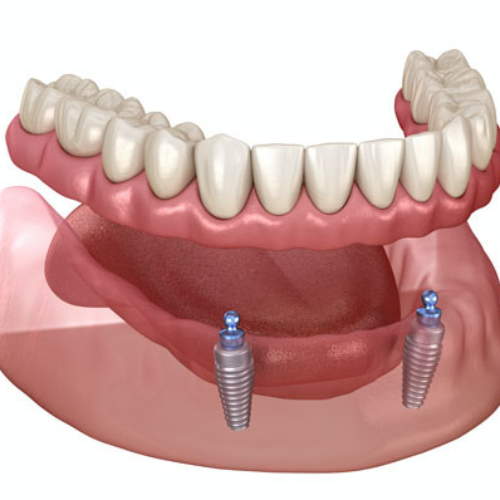 Dental Implants