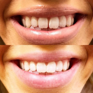 Teeth Whitening