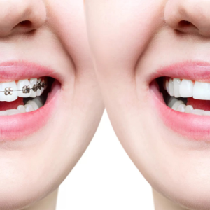 Braces Treatment