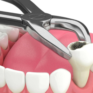 Extraction and Dentures