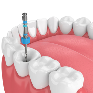 Root Canal Treatment