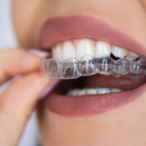 Clear Aligners