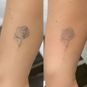 Tattoo Removal
