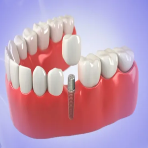 Best Dental Implants