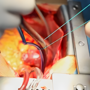 Cardiac Surgery