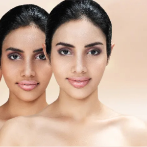 Chemical Peel Treatment