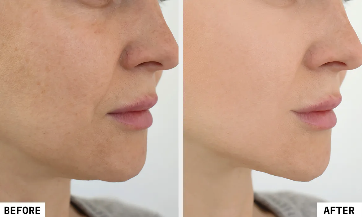 HIFU Facial - Image 2