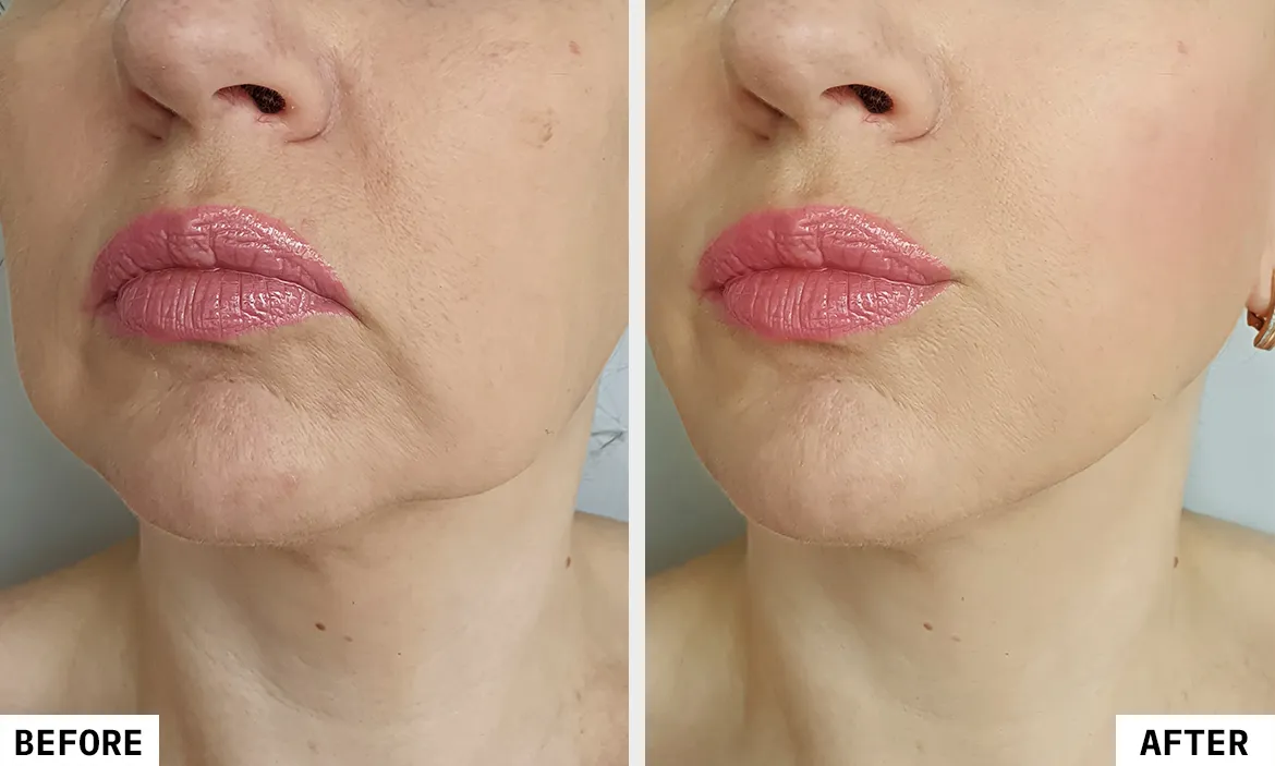 HIFU Facial - Image 3