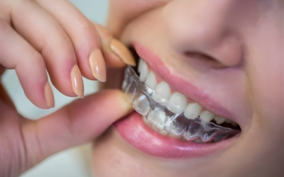 Expert Aligner Treatment Care for Best Dental Clinic in Delhi